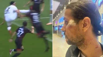 T&uuml;rk futbolunda skandallar bitmiyor! Futbolcuyu tanınmaz hale getiren faulde hakemin kararına kimse